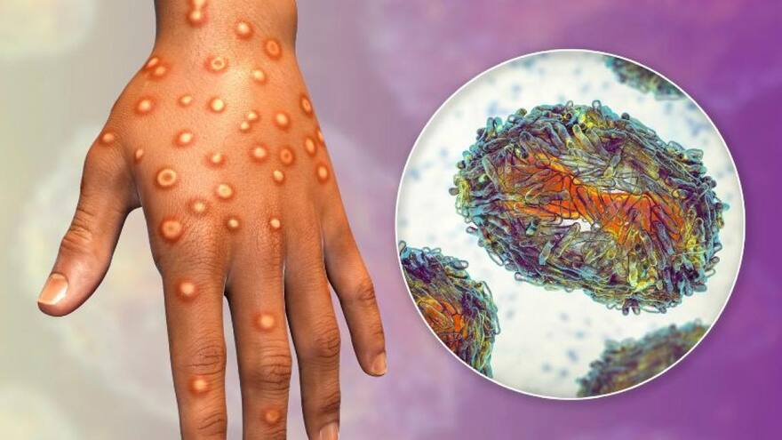 Identifican al primer linaje sudamericano de la viruela del mono