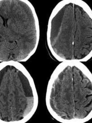 Hematoma subdural crónico