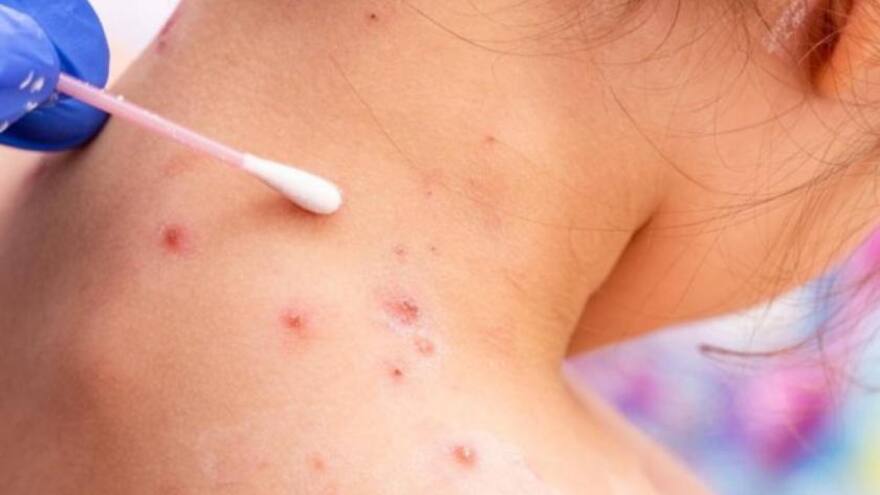 Alertan por nueva cepa mutante de viruela del mono que sería riesgo mundial