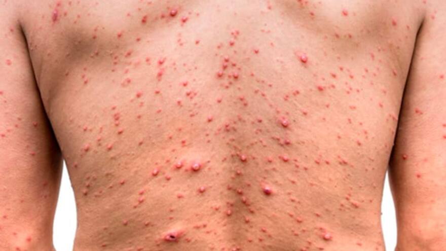 Confirman tres casos activos de viruela símica en Córdoba