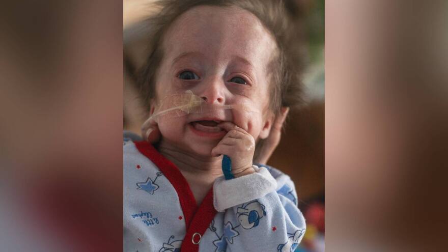 Vito, el bebé que nació con envejecimiento prematuro