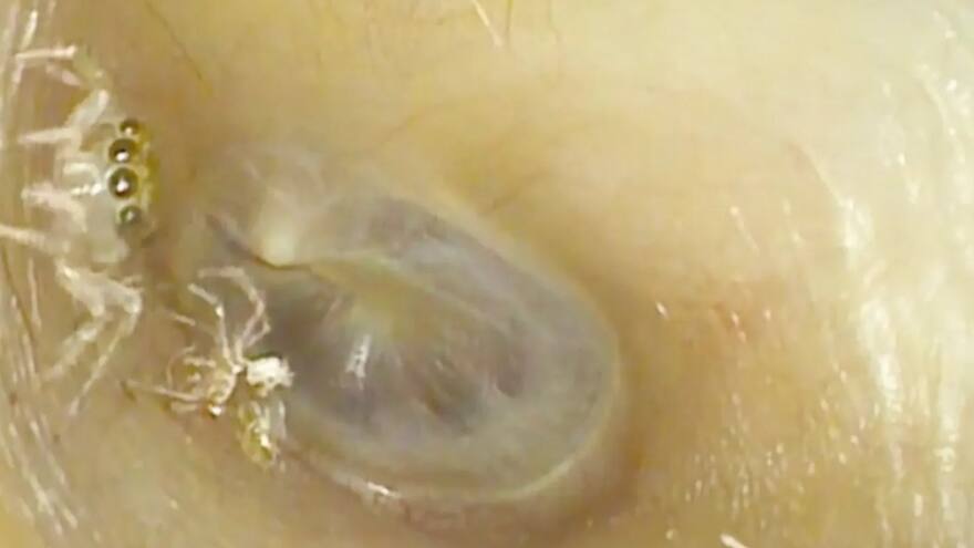 Encuentran una araña en el oído de una mujer