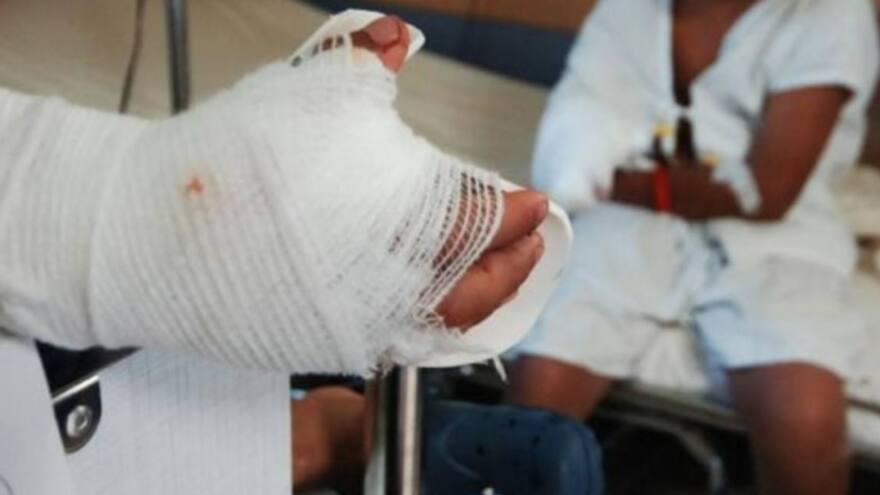 Córdoba registró el mayor número de quemados en la Costa Caribe