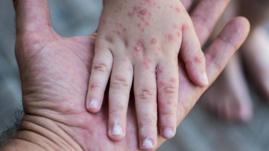 Viruela del mono: investigación revela nuevos síntomas en los contagiados