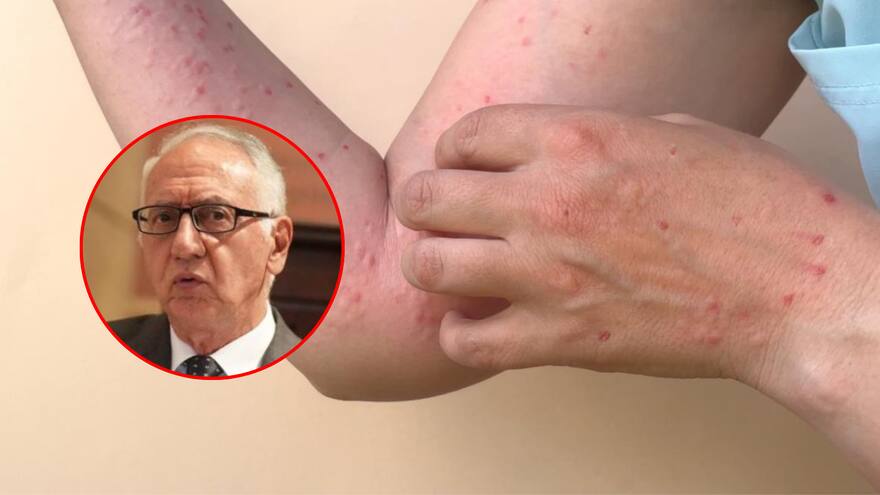 Mpox en Colombia | Nueva variante de la viruela símica no está en Colombia ni en América: Minsalud