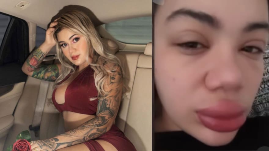 Cintia Cossio sufre de angioedema, ¿de qué se trata esta enfermedad?