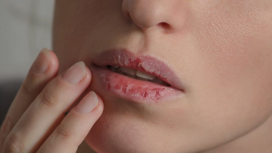 Labios secos: ¿cómo se pueden combatir?