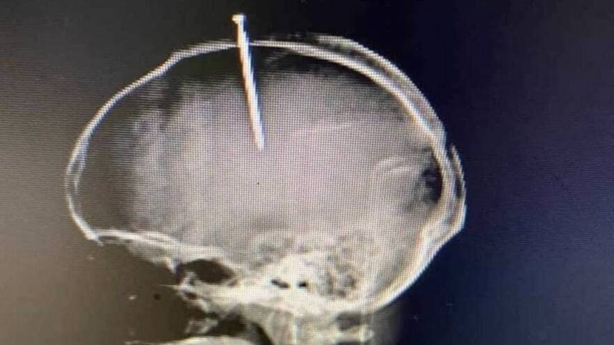 Se incrustó un clavo en su cabeza porque se sentía en 'cerebro flojo'