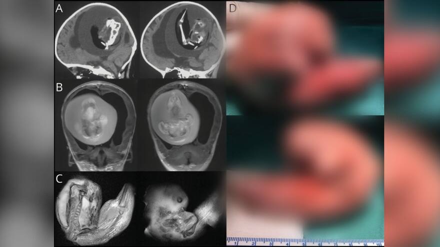 Video: Bebé nació con un feto en la cabeza y tuvo que ser operada de urgencia