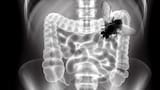 Hombre fue al médico por un dolor en los intestinos y le encontraron una mosca volando, en Estados Unidos