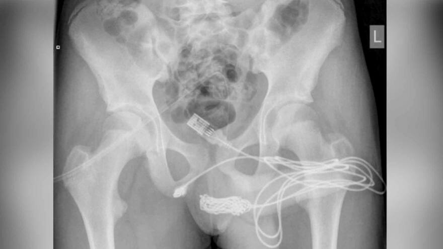 Por introducir cable USB en su uretra, menor es operado de urgencia