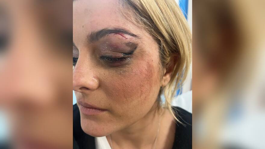 Cantante Bebe Rexha, herida en la cara por un fan que le lanzó el celular