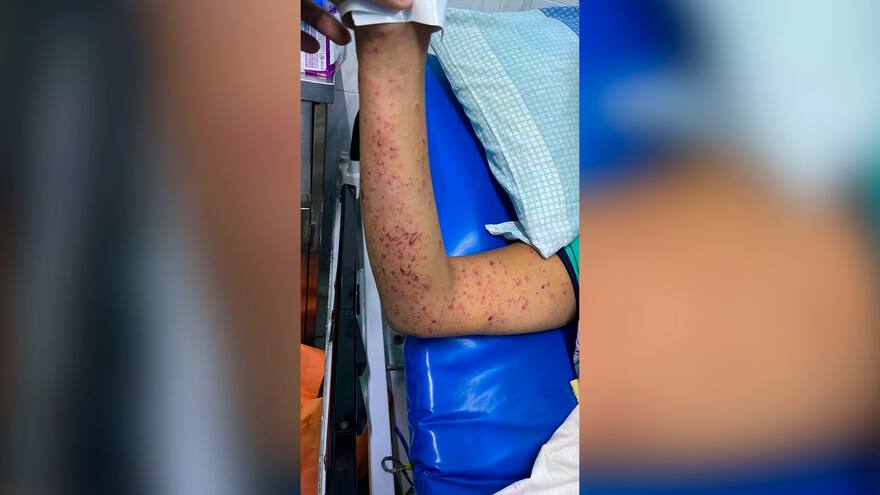 Se eleva la cifra de quemados con pólvora en Valledupar