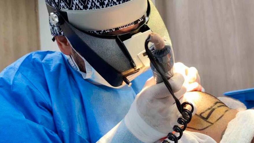 Microimplante capilar, la tendencia en auge en Colombia