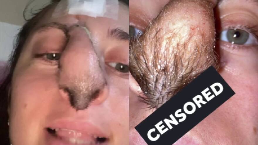 Mujer recibió injerto en cirugía y ahora le crece pelo en toda la nariz