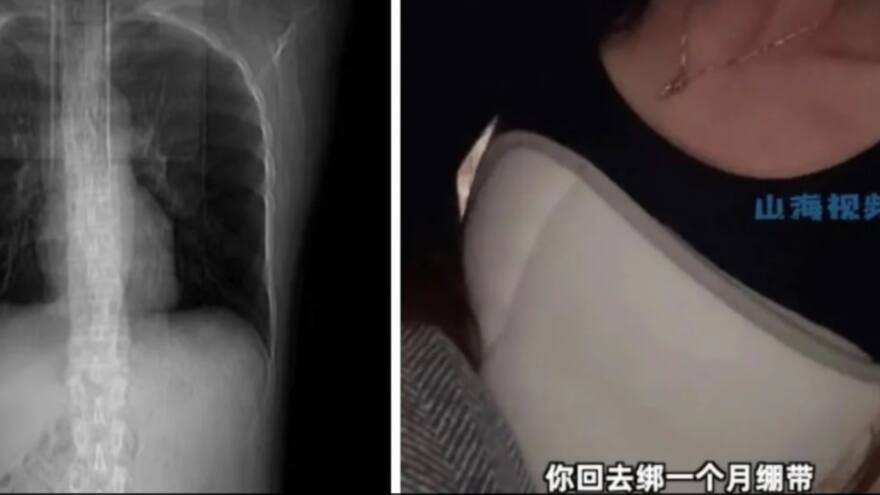 Mujer tosió tan fuerte que se fracturó cuatro costillas, luego de probar comida picante en China