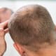Día mundial de la alopecia: nada que esconder, todo por vivir