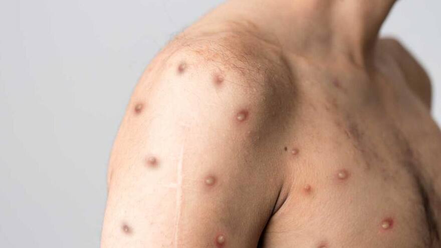 México reporta las primeras cuatro muertes por viruela símica