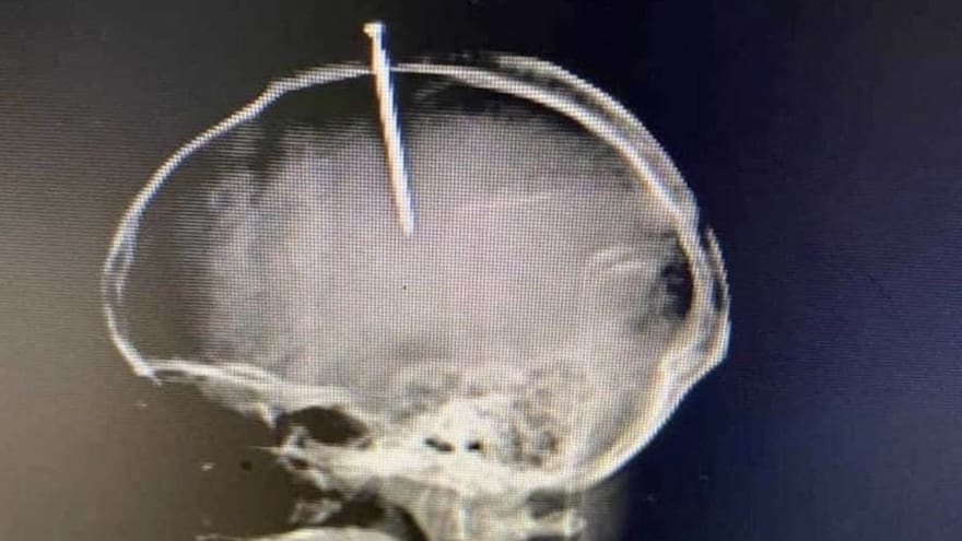 Se incrustó un clavo en la cabeza porque sentía el 'cerebro flojo'
