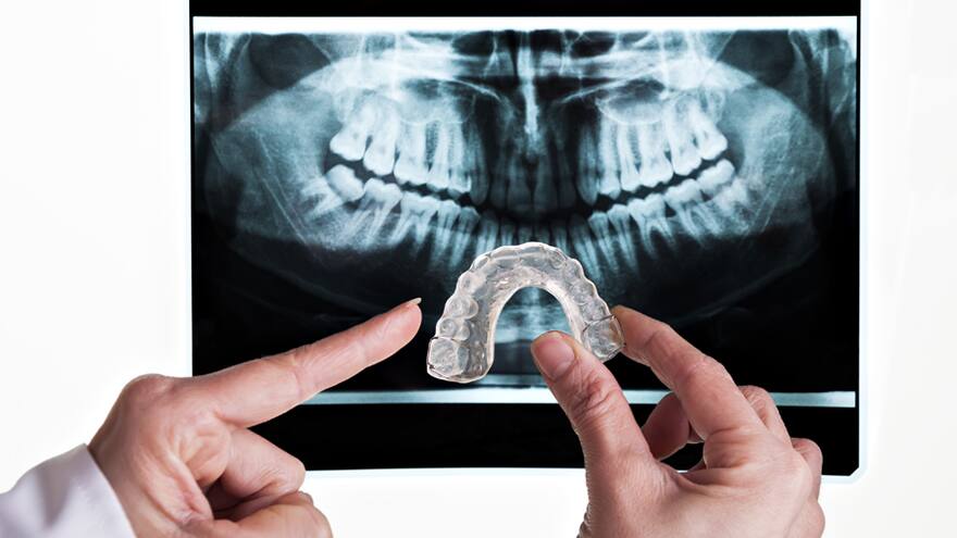 Ojo con el bruxismo, producto del estrés
