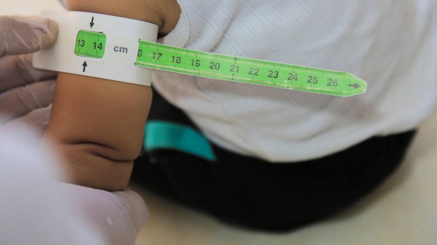 El impacto de la desnutrición crónica en el desarrollo económico de Colombia