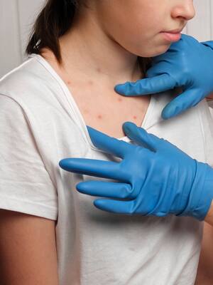 Viruela símica: ¿inminente pandemia? | Columna de José Consuegra