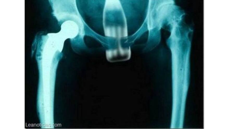 Menor de edad introdujo una botella en su recto y ahora deben practicarle cirugía