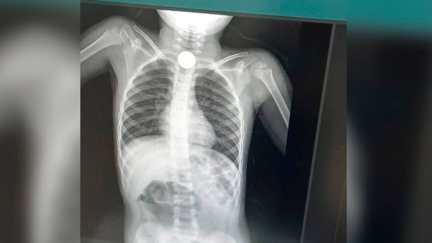 Magdalena: niño de dos años se tragó dos monedas en Ciénaga