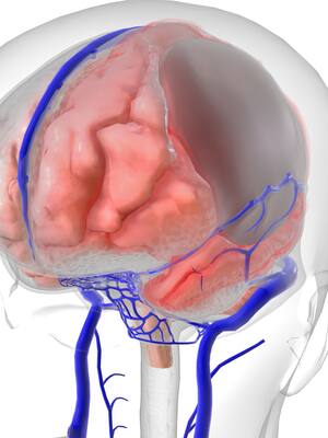 Activando el subdural