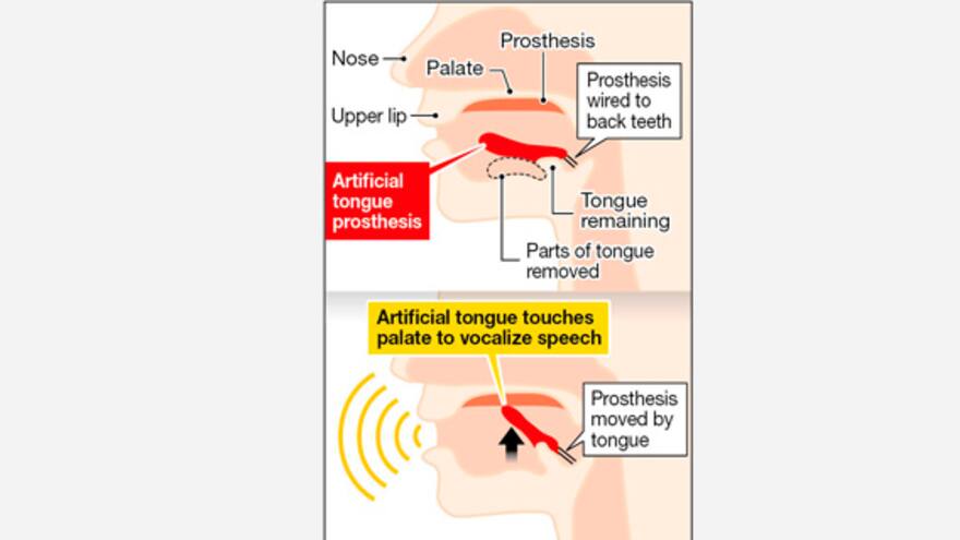 Desarrollan en Japón la primera prótesis movible de lengua para afectados de cáncer oral