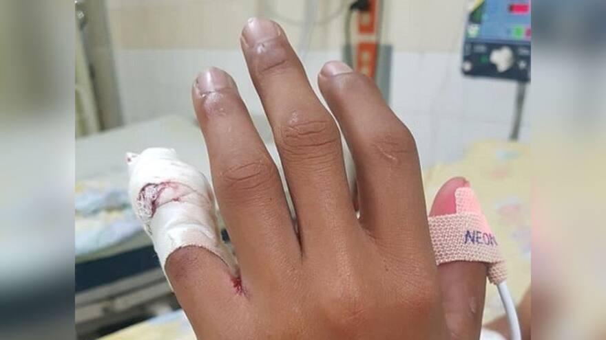 Niño de 12 años sufrió la amputación de sus dedos tras quemarse con pólvora