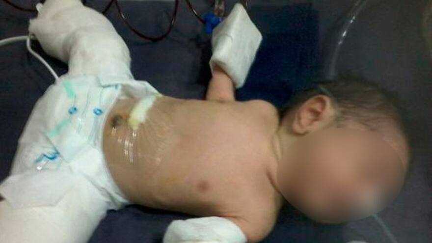 Extraño caso del bebé que nació 'embarazado' de su gemelo en la India