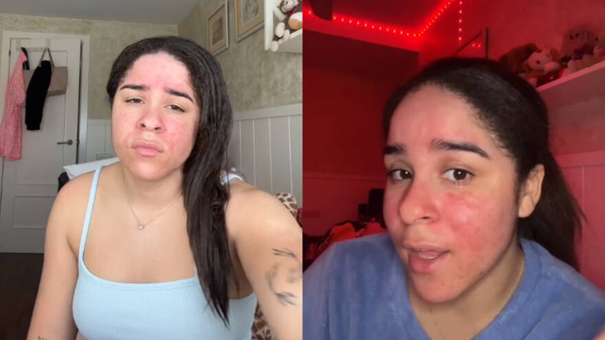 Así es la vida de la joven que es alérgica al agua: el sudor, la lluvia o sus lágrimas le causan irritación