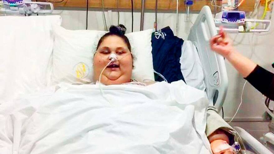 Mujer operada en India pierde 240 kilos tras dos meses de su cirugía