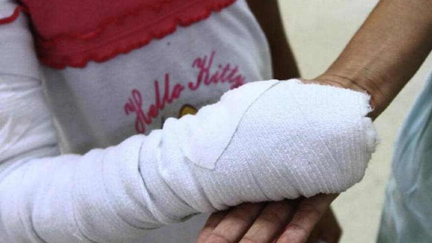 Niño perdió una mano tras manipular una bengala que halló su padre en Bogotá