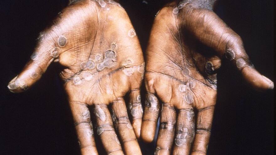 Viruela del mono: casos globales ascienden a 780, según la OMS