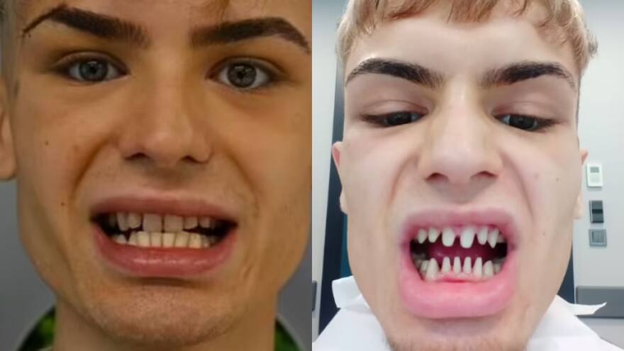 Joven modelo se hizo diseño de sonrisa que lo dejó con 'dientes de tiburón'