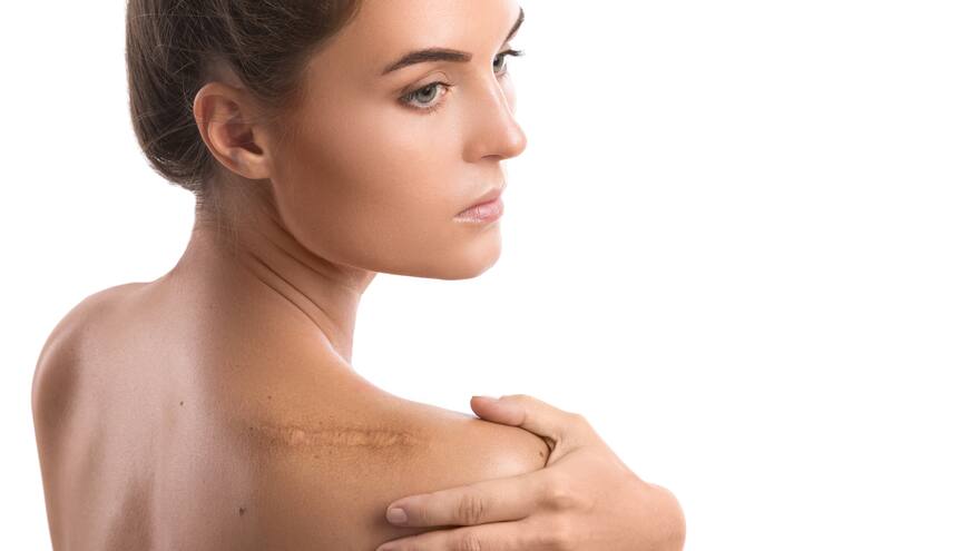 Transforma tus cicatrices: tips para mejorarlas