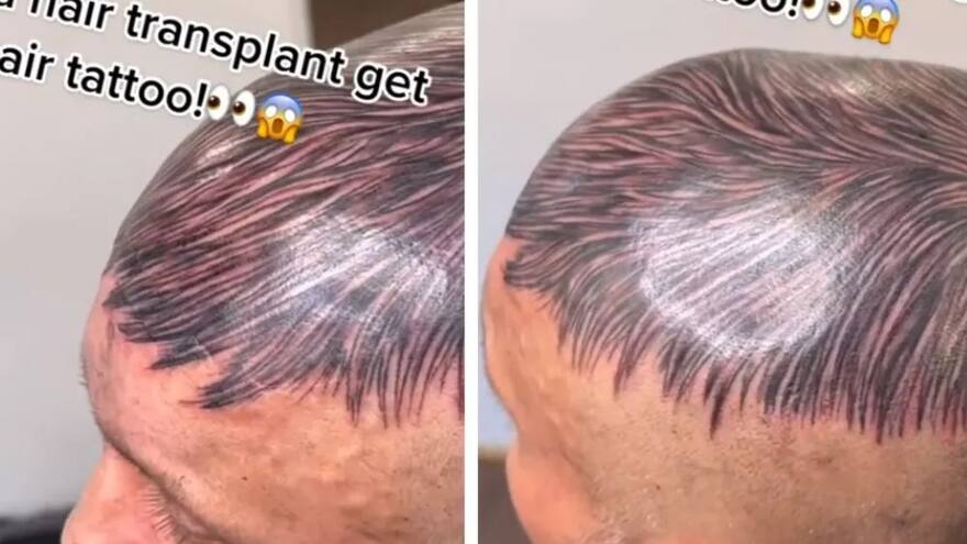Hombre se tatuó un peluquín para disimular la calvicie