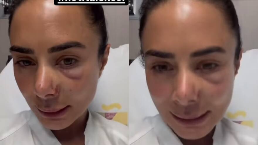 Johanna Fadul preocupó por moretones en su rostro: sufrió un accidente en reality de Telemundo