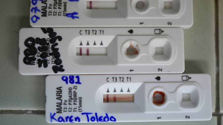 Referente investigativo de la malaria en Venezuela languidece en plena epidemia