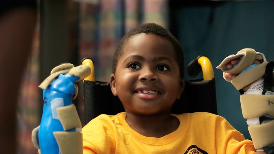 El primer trasplante de manos en un niño es un 'éxito': médicos