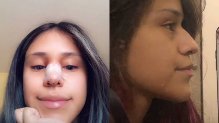 Mujer perdona infidelidad de su novio a cambio de una rinoplastia