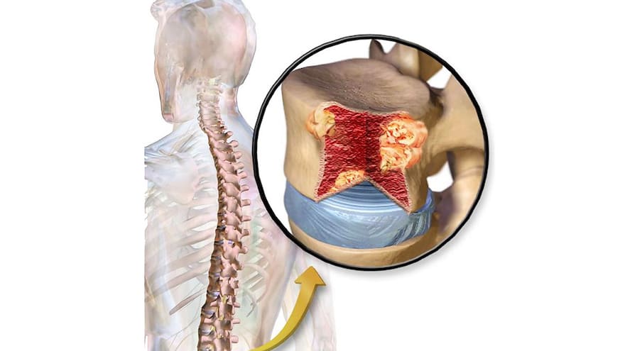 La lucha por el diagnóstico del mieloma múltiple