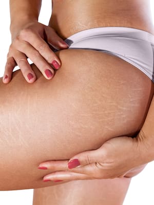 Estrías: ¿evitarlas o vivir con ellas?