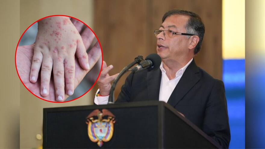 “Estamos en emergencia mundial por la posibilidad de una nueva pandemia”: Petro sobre virus mpox