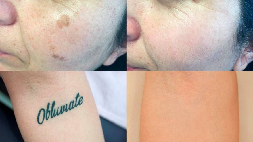 Última tecnología para remoción de tatuajes y manchas: Láser Picosegundos
