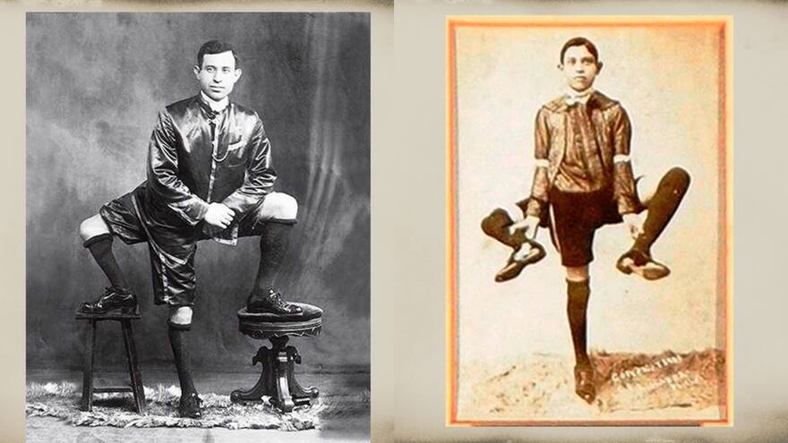 Frank Lentini, la estrella de circo en Italia que tenía tres piernas, cuatro pies y dos genitales