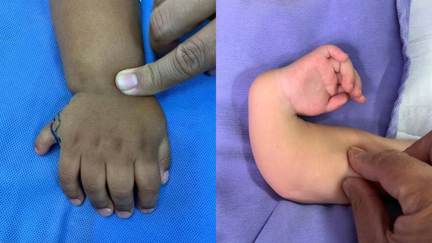 Brigada de salud gratuita en Barranquilla para niños con enfermedades congénitas en manos