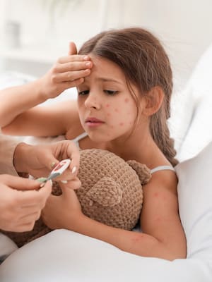 Viruela, entre el mono y los humanos | Columna de Álvaro Villanueva